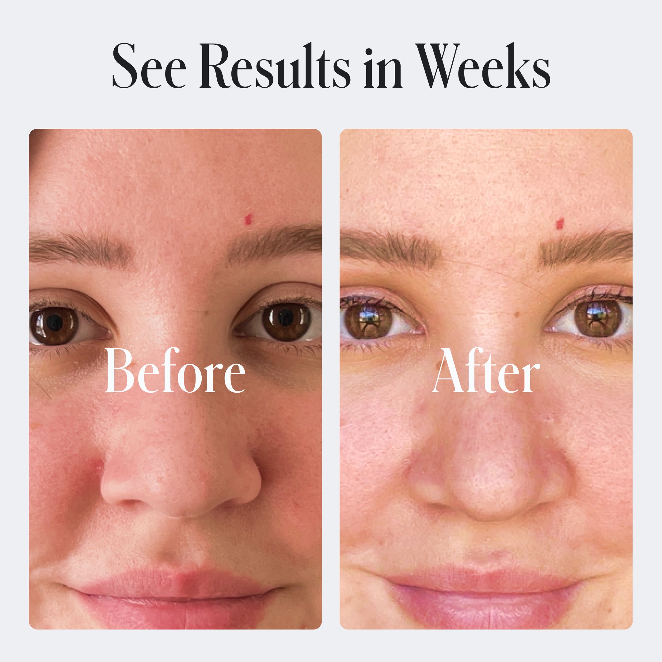 Side-by-side close-ups labeled Before and After, reveal reduced redness and clearer skin after using Geologie's Skin Repair Moisturizer with hyaluronic acid, under the text: See Results in Weeks.